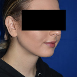 Chin Liposuction