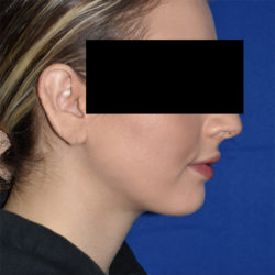 Chin Liposuction