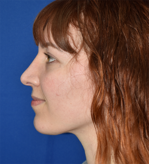 Rhinoplasty