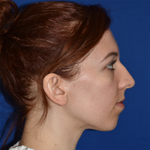 Rhinoplasty