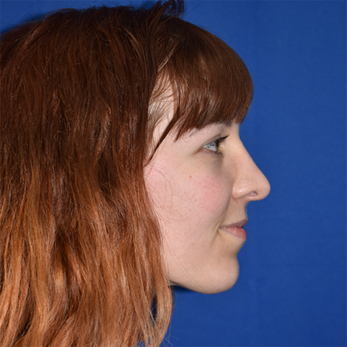 Rhinoplasty