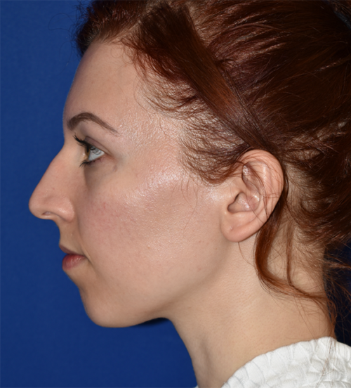 Rhinoplasty