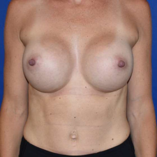 Breast Implant Revision