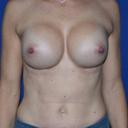 Breast Implant Revision