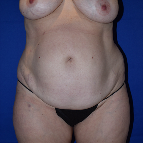 Abdominoplasty