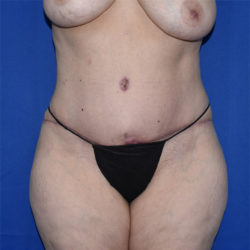 Abdominoplasty