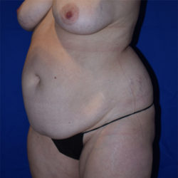 Abdominoplasty