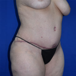 Abdominoplasty