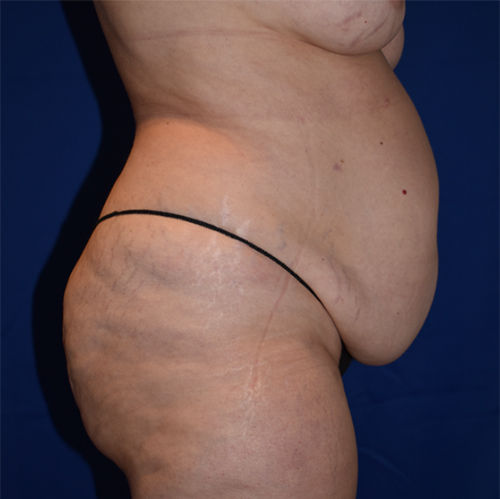 Abdominoplasty