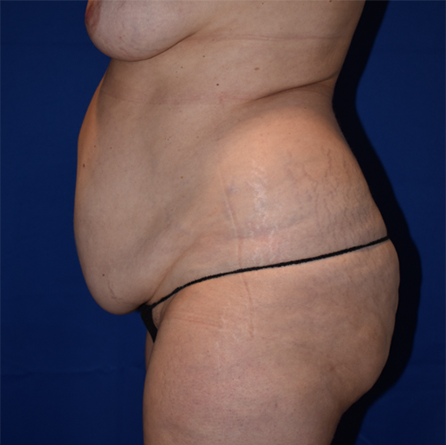 Abdominoplasty