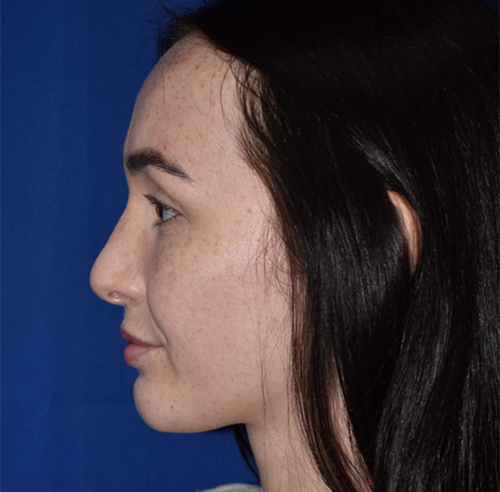 Rhinoplasty