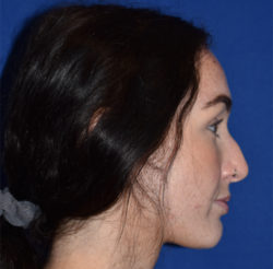 Rhinoplasty