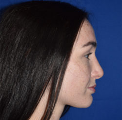 Rhinoplasty