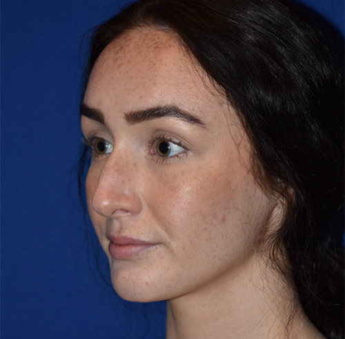 Rhinoplasty