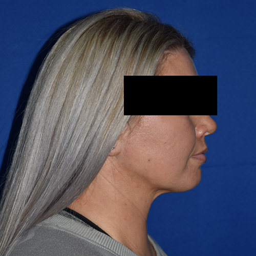 Chin Liposuction