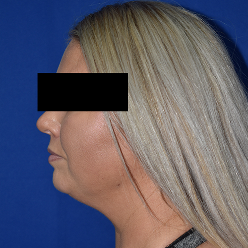 Chin Liposuction