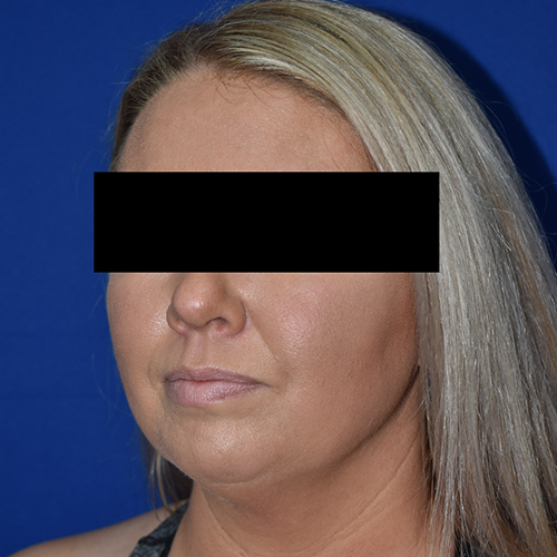 Chin Liposuction