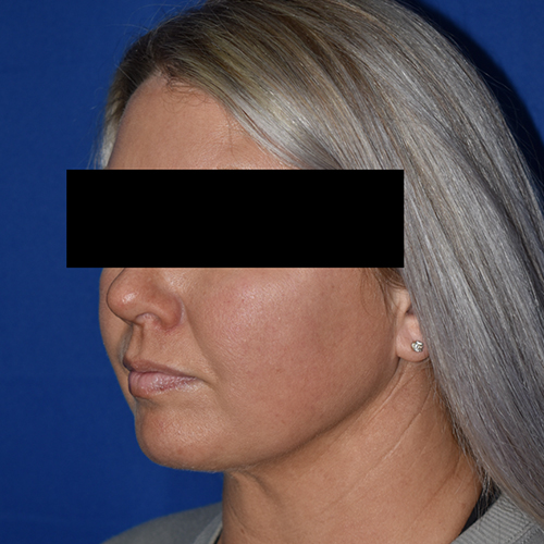 Chin Liposuction