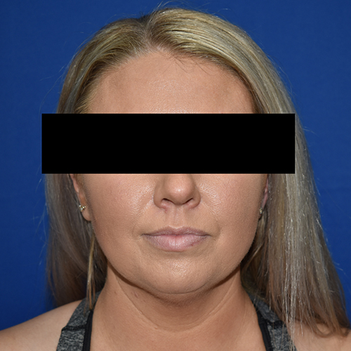 Chin Liposuction