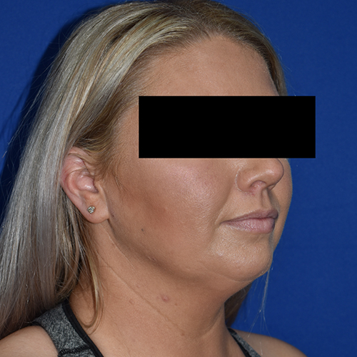 Chin Liposuction