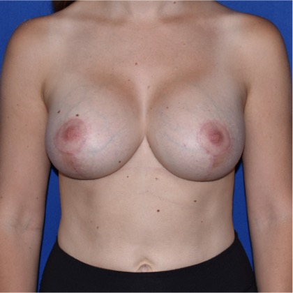 Breast Augmentation With Lift