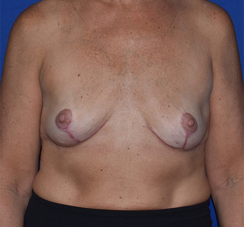 Breast Implant Removal