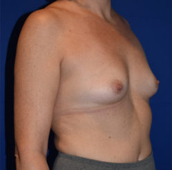 Breast Augmentation