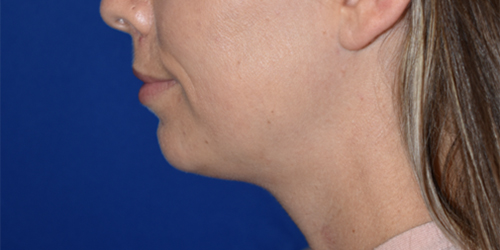 Chin Augmentation