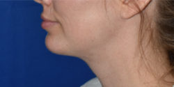 Chin Augmentation