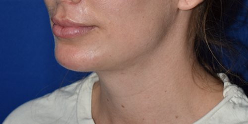 Chin Augmentation