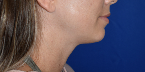 Chin Augmentation