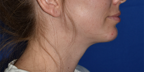 Chin Augmentation