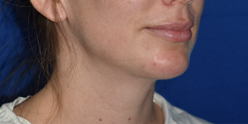 Chin Augmentation