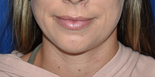 Chin Augmentation