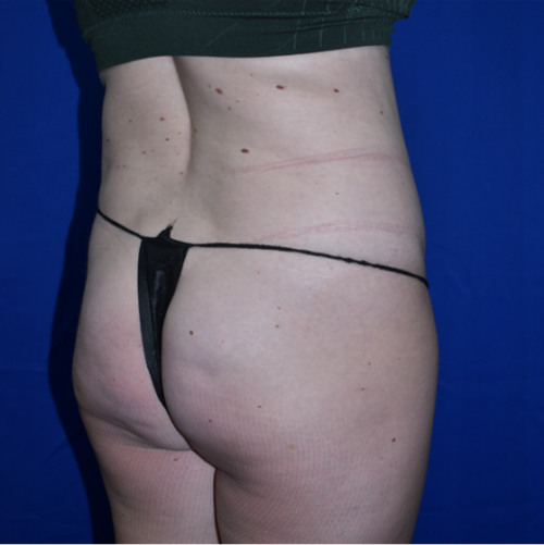 Abdominoplasty