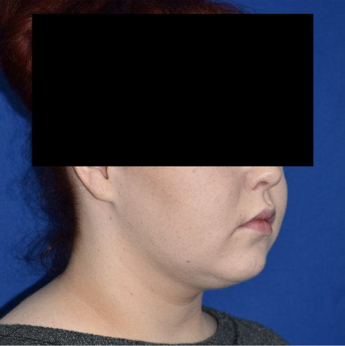 Chin Liposuction