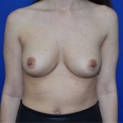 Breast Augmentation