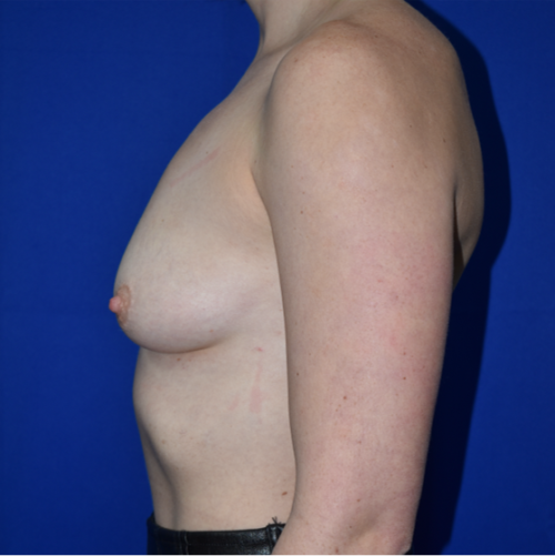 Breast Augmentation