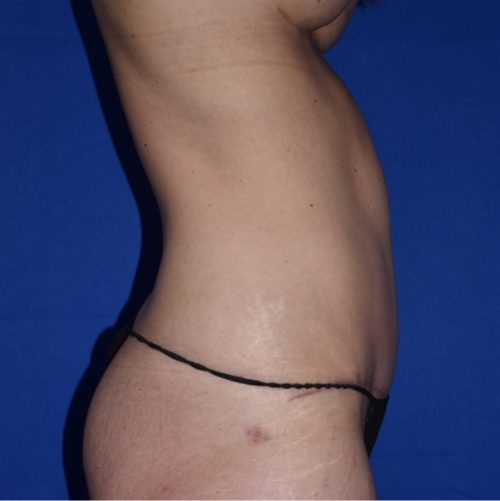 Abdominoplasty