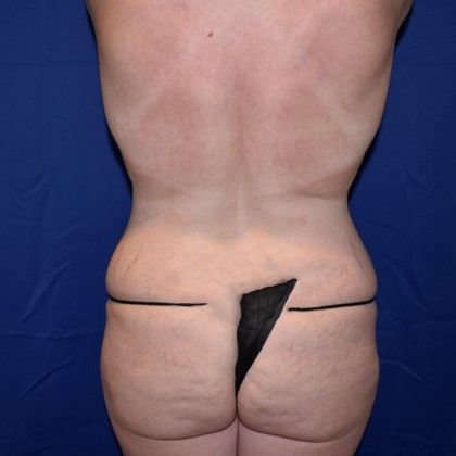 Abdominoplasty