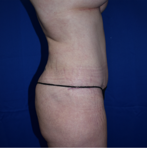 Abdominoplasty