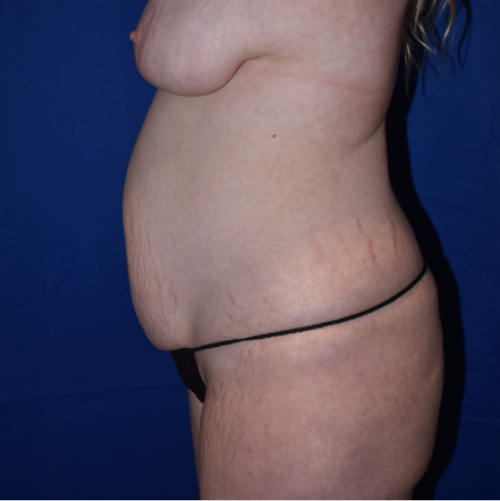 Abdominoplasty