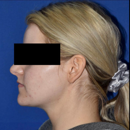 Chin Liposuction