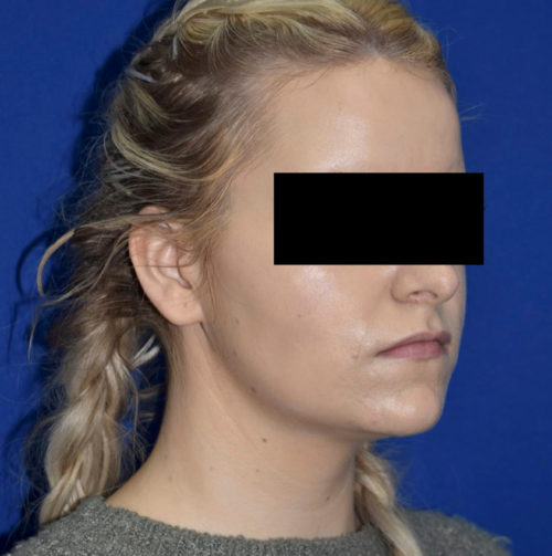 Chin Liposuction