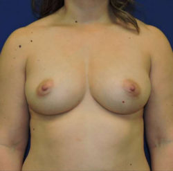 Breast Augmentation