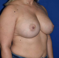 Breast Augmentation