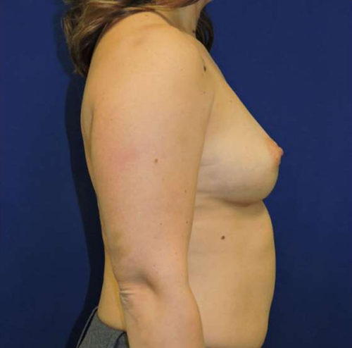 Breast Augmentation