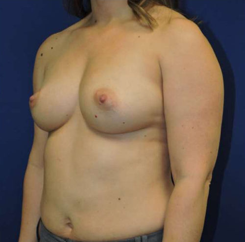 Breast Augmentation