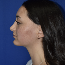 Rhinoplasty