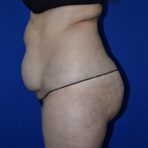 Abdominoplasty